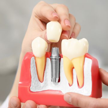 Are Dental Implants Right for You?