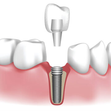 Dental-Implant_Blog