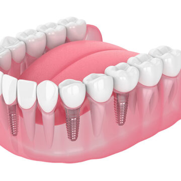 Design Considerations for Dental Implants