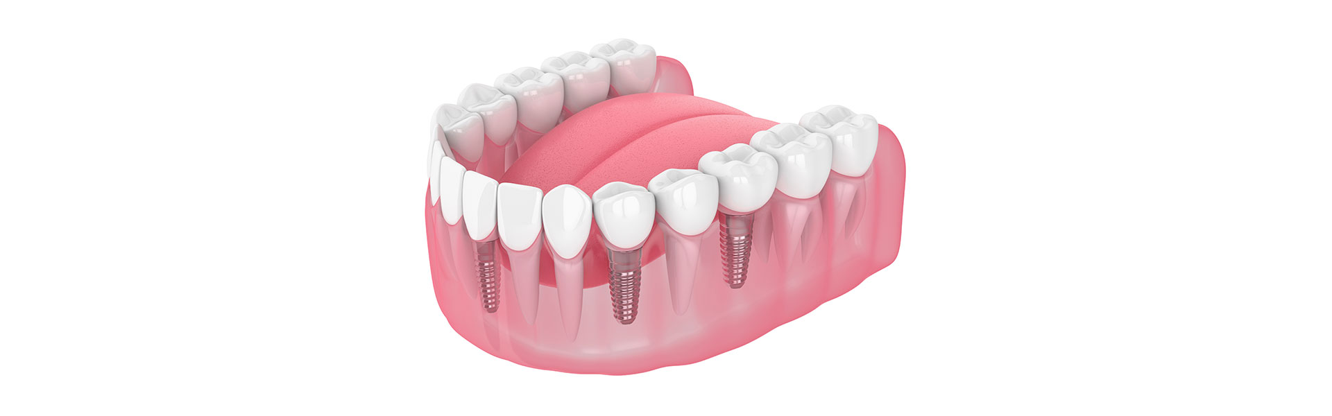 Design Considerations for Dental Implants