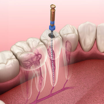 Understanding the Importance of Root Canal Treatment