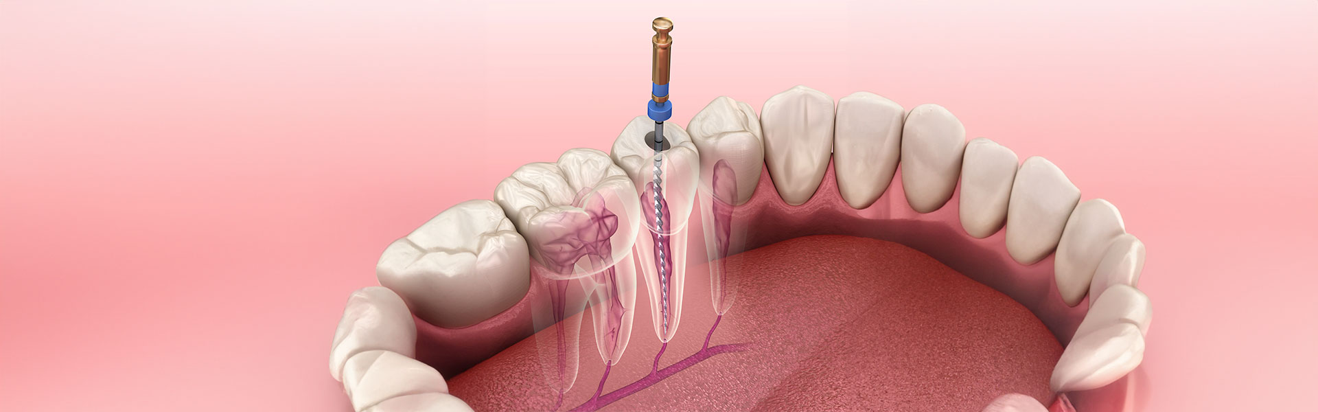 Understanding the Importance of Root Canal Treatment